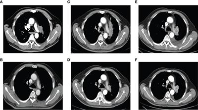Lung adenocarcinoma relapse with emerging EGFR mutation following complete response of small cell lung cancer warrants routine re-biopsy: A case report